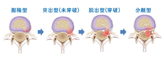 椎間板ヘルニアタイプ